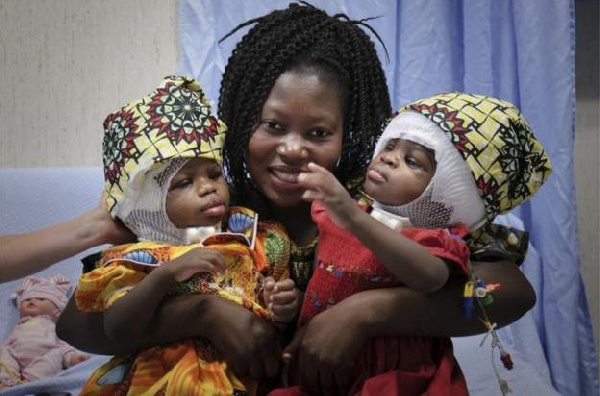 Ervina and Prefina, pictured last month with their mother, were born conjoined