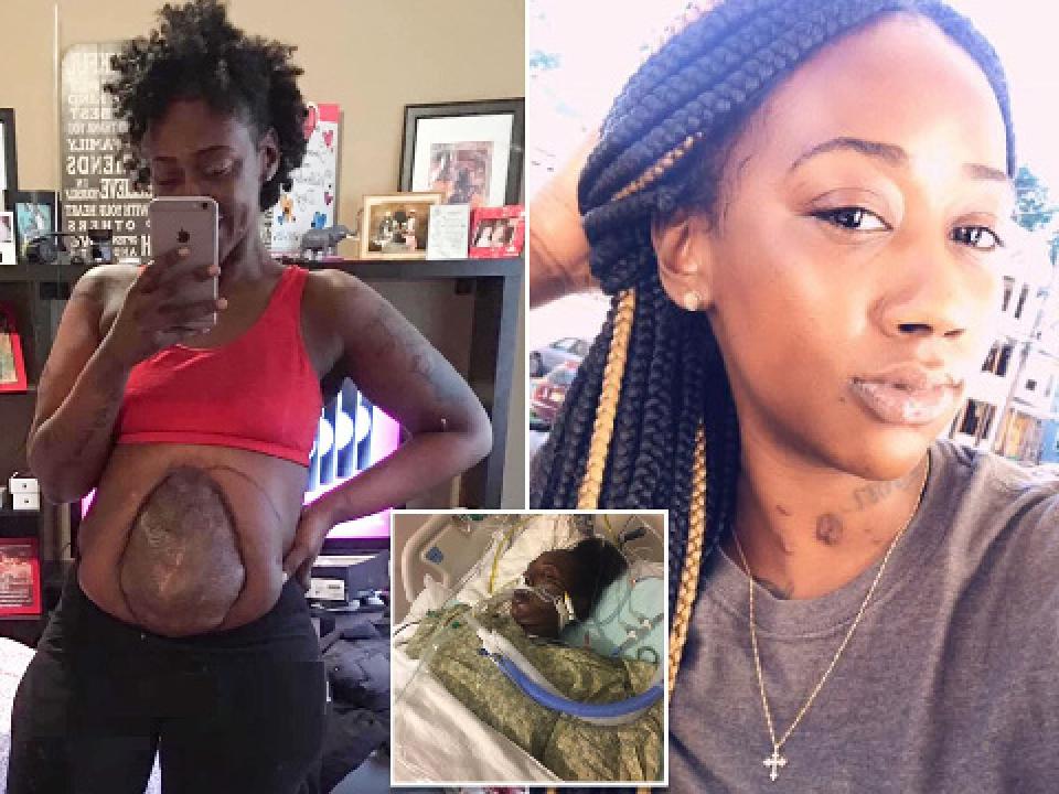 Takieyah Reaves now lives with her intestines hanging out of her abdomen