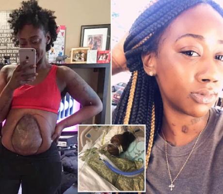 Takieyah Reaves now lives with her intestines hanging out of her abdomen