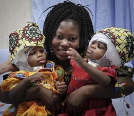 Ervina and Prefina, pictured last month with their mother, were born conjoined